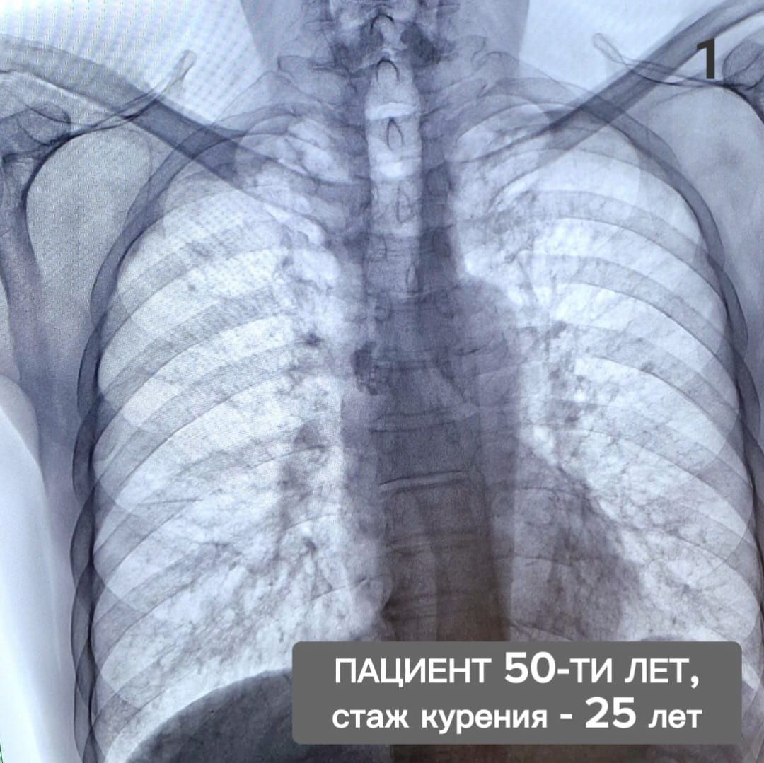 Врач-рентгенолог из Челнов сравнил снимки легких курящего и некурящего  человека | 31.05.2023 | Набережные Челны - БезФормата