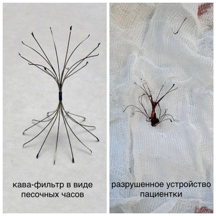 Не помогли в Израиле: женщину с разрушенным кава-фильтром спасли в БСМП Челнов