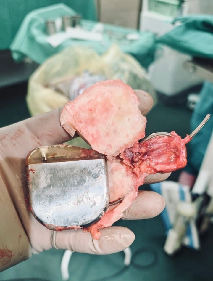 Хирурги БСМП удалили кардиостимулятор женщине, который врос в ее тело