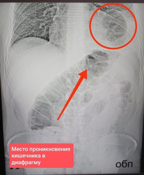 Кишечник в груди: в Татарстане прооперировали пациента с редкой патологией Кишечник в груди: в Татарстане прооперировали пациента с редкой патологией