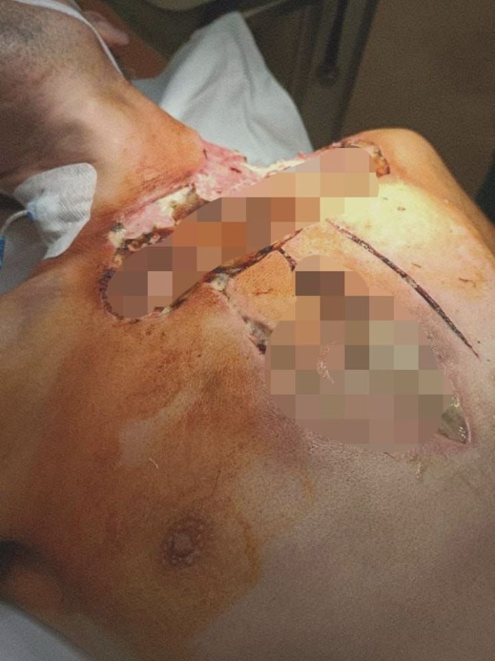 Через дыру видел свое легкое: в Челнах спасли мужчину, упавшего со стремянки Через дыру видел свое легкое: в Челнах спасли мужчину, упавшего со стремянки