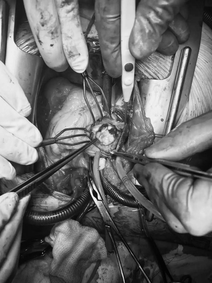 Держалась на «ножке»: в БСМП пациентке удалили опухоль размером с мяч для гольфа