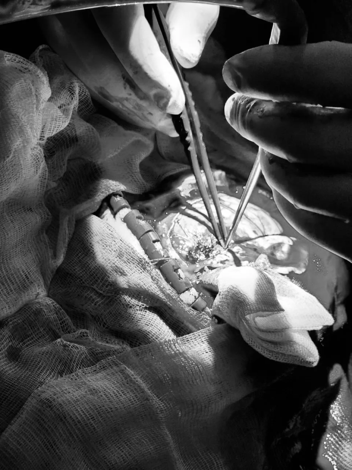 Врачи БСМП Челнов спасли многодетную мать с массивным кровоизлиянием в мозг